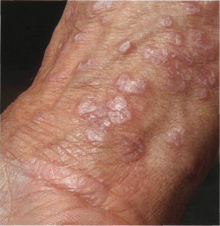 Сыпь на члене или головке у мужчин высыпания в виде красных точек