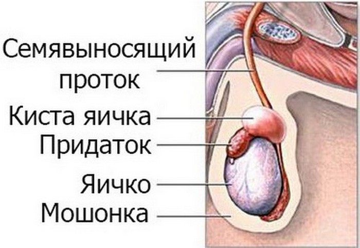 семенная киста